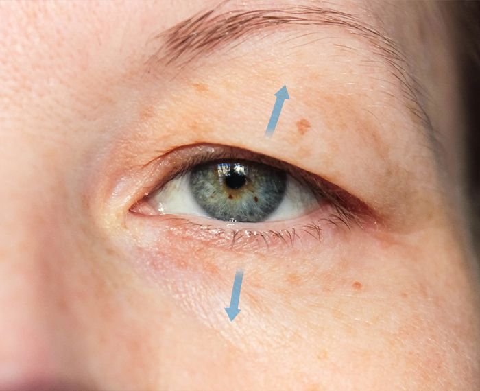 goz_kapagi_ameliyati