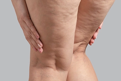 lipodem-nedir