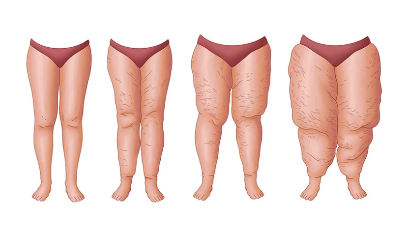 ameliyatsiz-lipodem-izmir