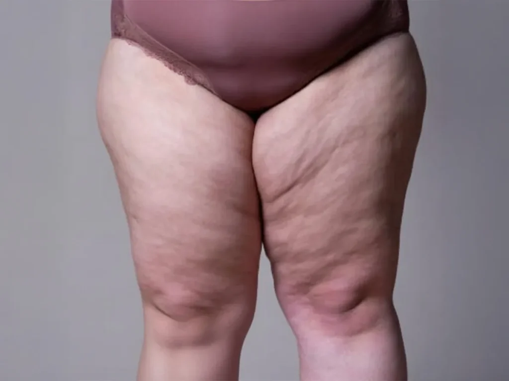 lipodem